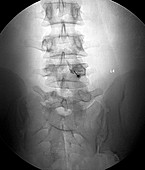 Back pain treatment,X-ray