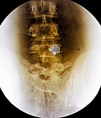 Back pain treatment,X-ray