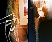 Total hip replacement,X-rays