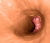 Colon cancer,3D colonoscopy image