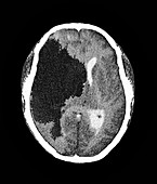 Stroke,CT scan