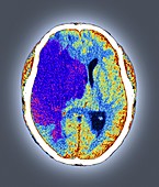 Stroke,CT scan