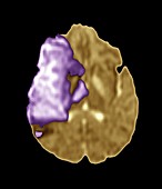 Stroke,MRI scan