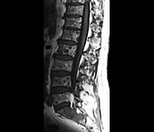 Spinal cancer,MRI scan