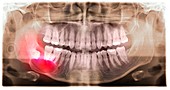 Impacted wisdom tooth,panoral X-ray