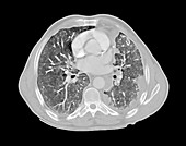 Mesothelioma lung cancer,CT scan