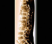 Secondary spinal cancer,MRI scan