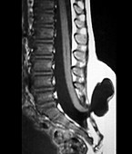 Spina bifida,MRI scan