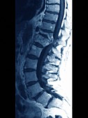 Tuberculosis of the spine,MRI scan