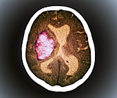 Stroke,CT scan