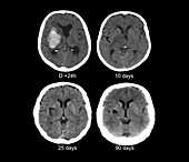 Stroke,CT scans