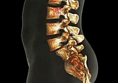 Spondylolisthesis,CT scan