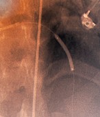 Coronary stenosis treatment,X-ray