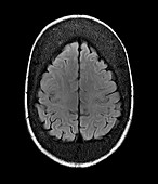 Thickened skull,MRI scan