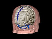 Thrombophlebitis in the brain,3D CT scan