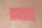 Allergic reaction to skin patch