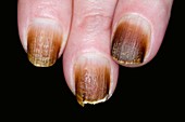 Fungal nail infection