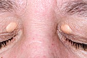 Xanthelasma on the eyelids