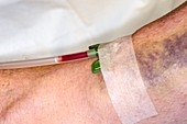 Haemodialysis: cannula in arm