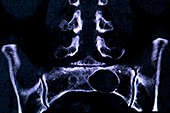 Tarlov spinal cyst,MRI scan