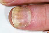 Psoriasis of the fingernail