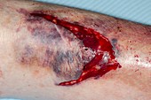 Laceration of shin from a fall