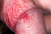 Herpes infection on the penis