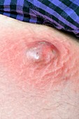 Abscess on the thigh