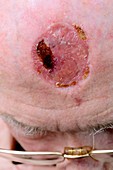 Cancer skin graft on the forehead