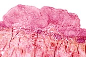 Cervical wart,light micrograph