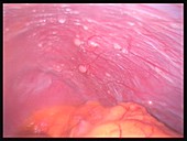 Ovarian cancer,laparascopic image