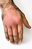 Cellulitis of the hand