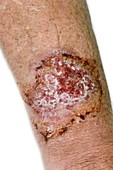 Infected ulcer