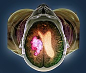 Stroke,MRI and 3D CT scans