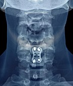 Neck arthritis treatment,X-ray