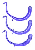 Mitral valve annuloplasty,artwork