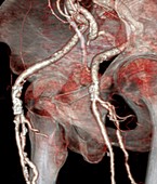 Atherosclerosis,3D CT scan