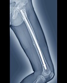 Pinned thigh fracture,X-ray