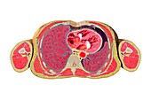 Pneumothorax cross-section,artwork