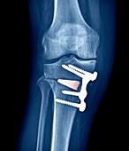 Knee realignment surgery,X-ray