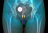 Artificial urinary sphincter,X-ray