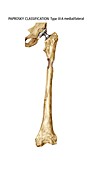 Paprosky femur defect,type IIIA med-lat
