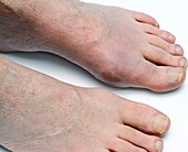 Gout in the foot