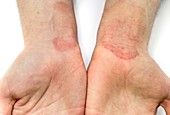 Contact dermatitis on the wrists