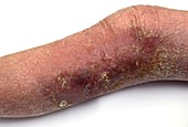 Eczema on the lower leg