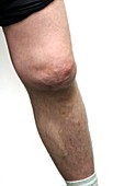 Knee effusion from sport's injury