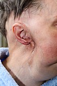 Parotid tumour after removal