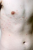Pityriasis rosea rash on the body