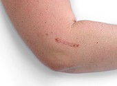 Scar from tennis elbow surgery