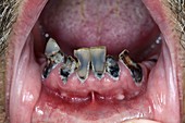 Tooth decay (dental caries)